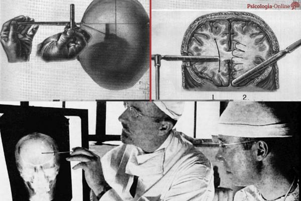 What is a lobotomy and what is it for - What is a lobotomy