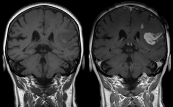 איסכמיה במוח: מה זה, גורם, תסמינים, השלכות וטיפול