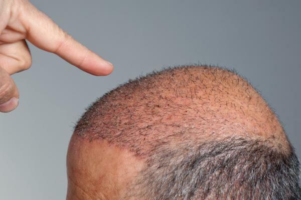 Närvipõletik: mis see on, sümptomid ja ravi - kas juuksed kasvavad pärast alopeetsiat?
