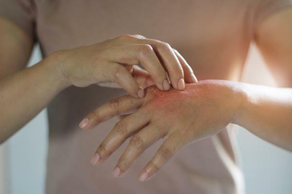 Dermatillomanie: wat het is, oorzaken, symptomen en behandeling