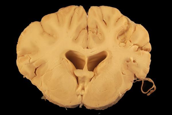 Substanța albă a creierului: definiție, structură, funcții și leziuni